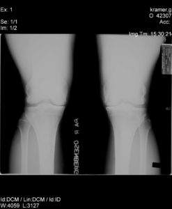 knee-x-rays0002