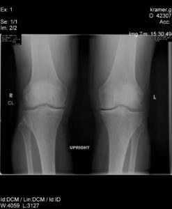 knee-x-rays0003